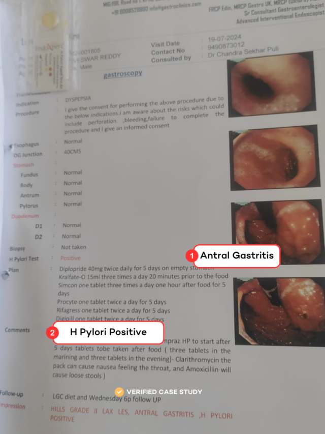 H Pylori in 21 Days