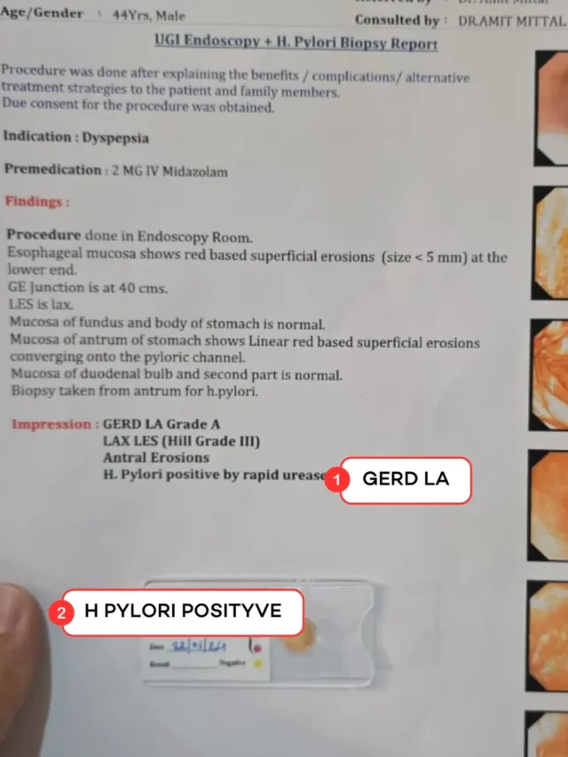 Acidity in 60 Days